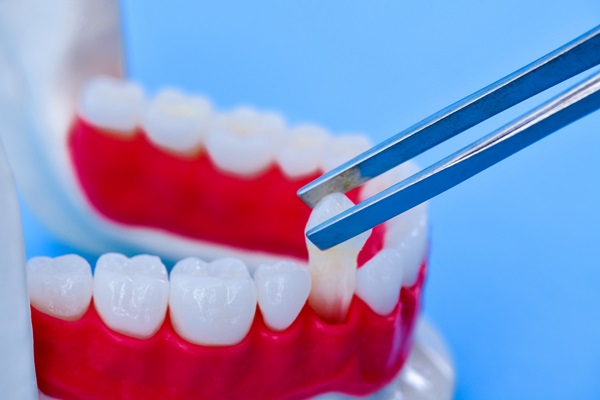 What Are The Advantages Of Getting Dental Implants